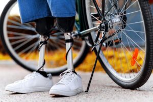 Prosthetics in Abuja